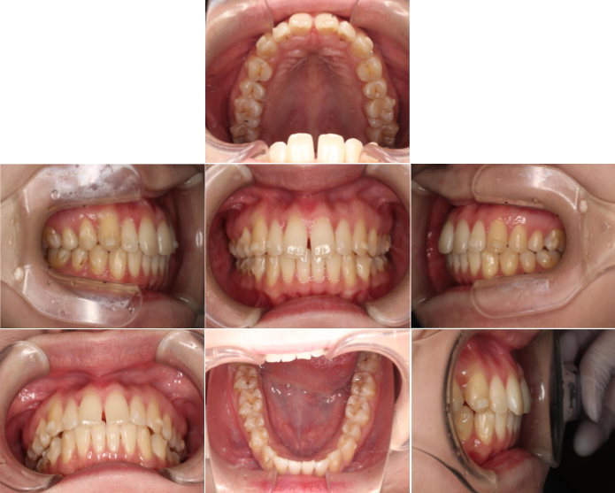 インビザラインによる、前歯のすきっ歯矯正。治療中