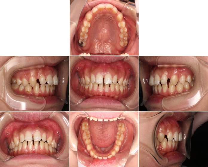 インビザラインによる、全体的なすきっ歯矯正。治療前