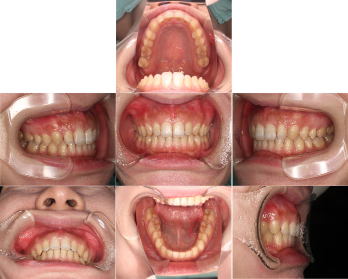 インビザラインによる、全体的なすきっ歯矯正。治療後