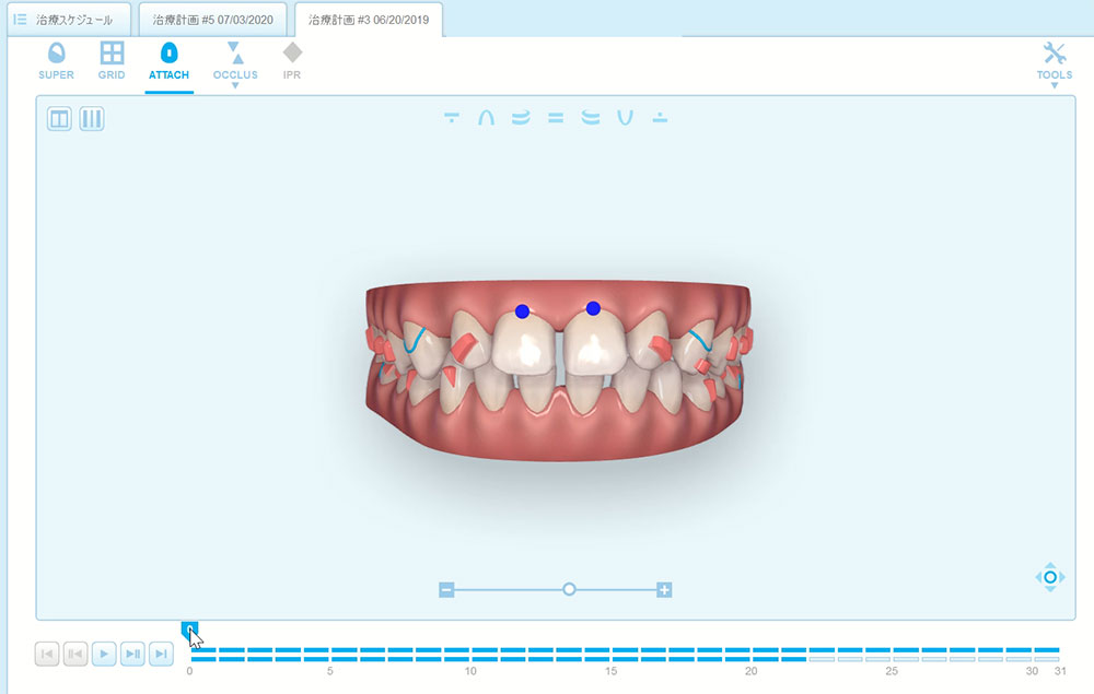 インビザラインによる、全体的なすきっ歯矯正。シュミレーション