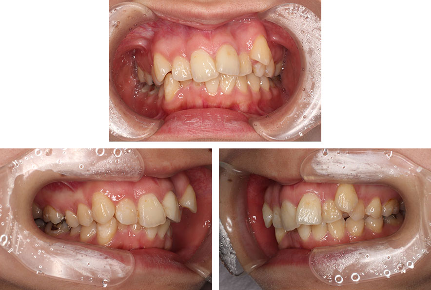 表側矯正(セラミックブラケット)による、上下の前歯のガタガタ・出っ歯・ディープバイト矯正。治療前