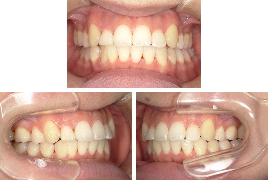 第一小臼歯抜歯・表側矯正による、前歯のガタガタと過蓋咬合（ディープバイト）矯正。治療後