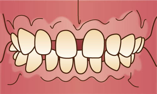 空隙歯列弓（スペースアーチ）