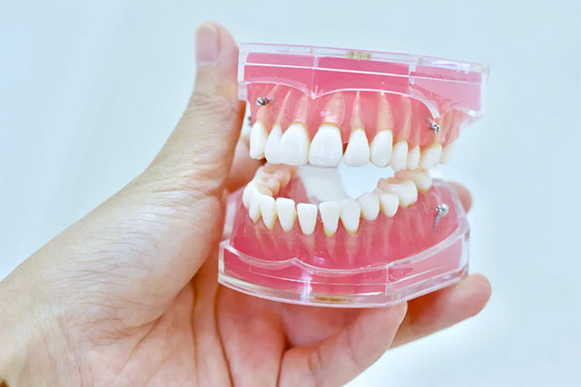 開咬（オープンバイト）矯正のための歯科矯正用アンカースクリューイメージ