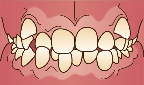 ガタガタ・ガチャ歯（叢生、乱杭歯）