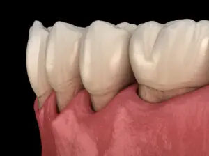 ガタガタ・ガチャ歯（叢生、乱杭歯）が原因で虫歯や歯周病になったイメージ