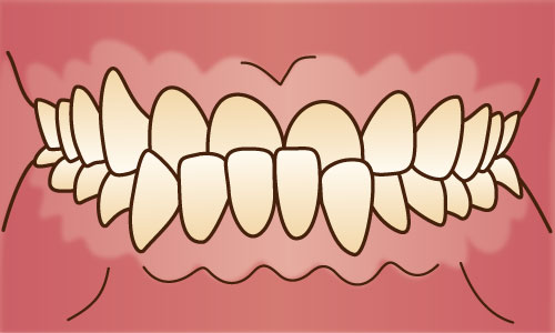 受け口・反対咬合・しゃくれ（反対咬合）